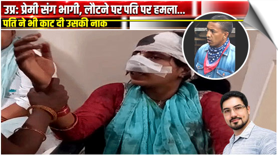 UP | Woman claims husband bit off her nose; in-laws allege she bit his private parts