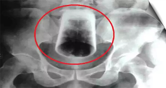 A person sitting on a drunken glass; It entered directly into the stomach, this happened after 3 days